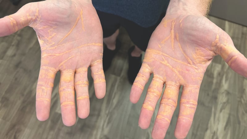 A man developed yellow-colored nodules on his palms, soles, and elbows due to high cholesterol...